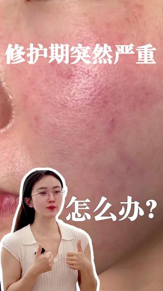 修护期突然严重怎么办?#问题肌#大红脸#皮肤屏障受损怎么修复 #护肤#护肤分享