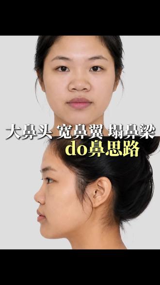 大鼻头宽鼻翼塌鼻梁的do鼻思路 #做鼻子 #审美 #隆鼻 #广州