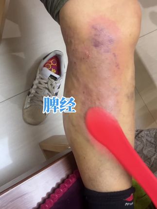 #记录生活 #刮痧 #拍打#郑州经络拍打