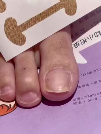 真的后悔没有早点用#脚指甲往肉里长怎么办 #足部护理 #嵌甲