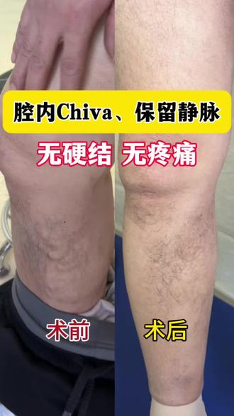 静脉曲张微创患者术前术后记录,腔内Chiva,保留静脉,无硬结、无疼痛!#静脉曲张微创 #术前术后对比 #沧州静脉曲张冀景刚 #腔内Chiva手术 #医疗科普