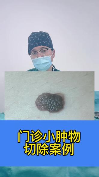 门诊小肿物切除手术案例~#医学科普 #切痣 #肉痣 #手术室日常 #徐威龙整形医生