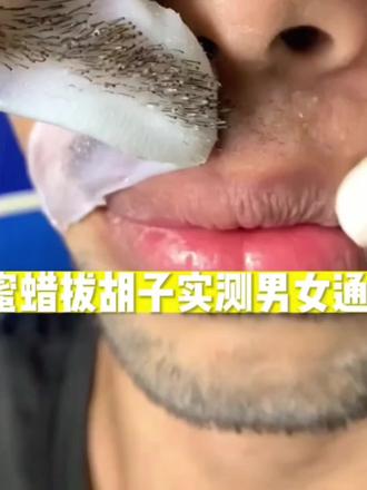 #蜜蜡脱毛 #脱毛神器 #我要上有用榜 #修面 蜜蜡物理脱毛,破坏毛囊拔除毛根,男女都适用!您需要把毛发留到零点五厘米以上哦!效果如您所见哈!