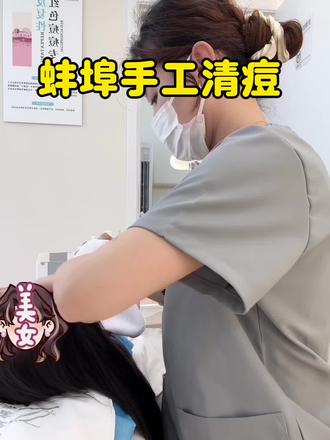 蚌埠 | 一家专注手工清痘的店#蚌埠祛痘#手工清痘#全脸针清#闭口粉刺怎么去除