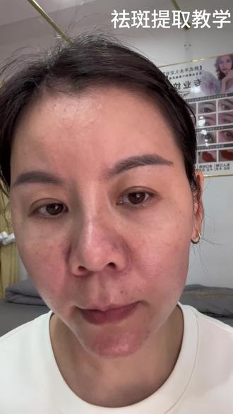 祛ban打卡第一天,斑斑点点从有到无全记录#美白#祛斑#上热门
