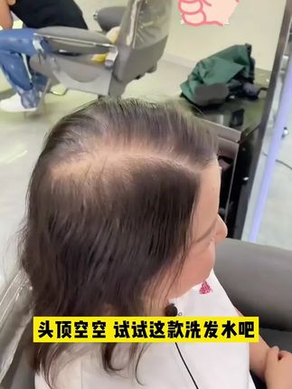 #生发 #育发液 #固发防脱 #掉发的烦恼 #掉发严重怎么办