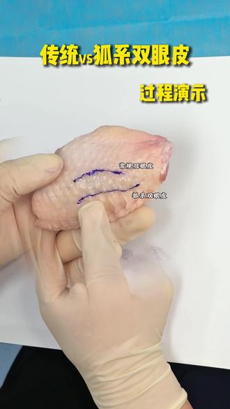 传统双眼皮和狐系双眼皮的区别点#双眼皮手术 #医学科普 #董瑞芳双眼皮 #知识科普 #狐系双眼皮