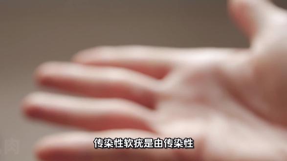 每日健康科普【传染性软疣】的症状及预防#健康 #健康科普 #软疣 #科普 #原创