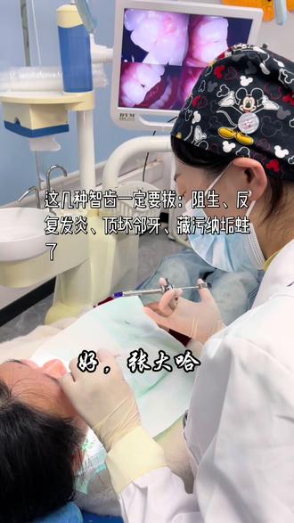 第一视角带你看拔智齿全过程#牙齿保护计划 #创作者中心#拔智齿 #智齿 #牙医日常