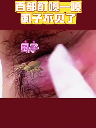 复方百部酊喷剂#虱子 #虱子卵 #消除虱子卵的小妙招 #虱子是怎么来的 #身上长虱子怎么消除
