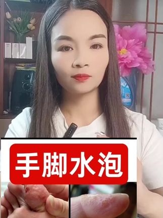 手上脚上起小水泡止痒膏#百草膏#手足护理#好物分享