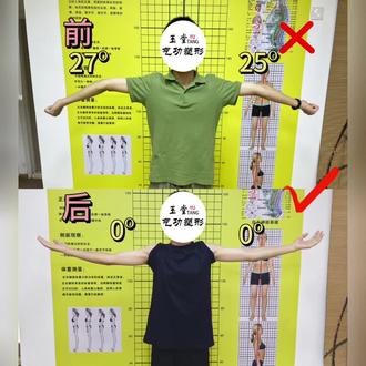 肘过伸现在发现为时不晚 肘过伸超过15度不合格#肘过伸#军检#警检#当兵