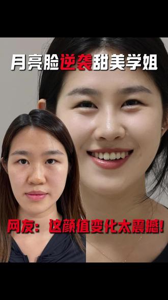 月亮脸逆袭甜美学姐!#李劲良鼻整形 #隆鼻 #鼻整形 #肋骨鼻 #月亮脸
