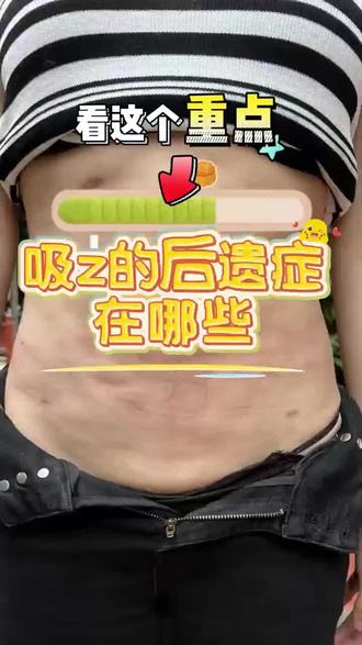 吸脂的后遗症有哪些#吸脂手术 #吸脂 #塑型