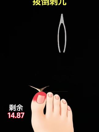 #拔倒刺挑战