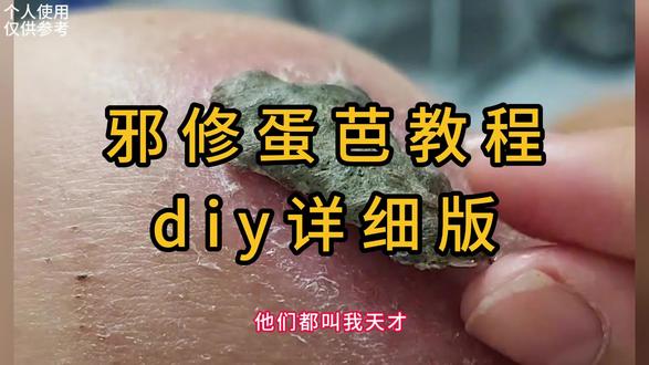 diy🥚芭教程来啦#疤痕 #zocc硅酮凝胶 #祛疤 #剖腹产