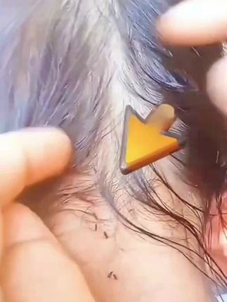#虱子#头虱#虱子卵#虱子洗发水  #好物推荐🔥