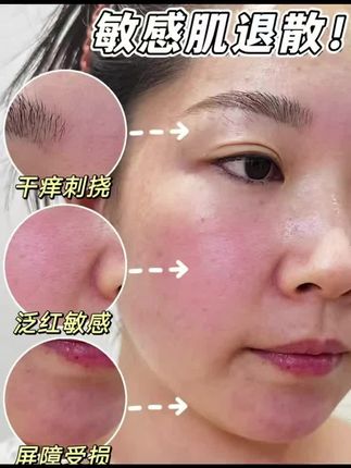 普纤娜1盒5片医用透明质酸钠修护贴人体浅表性创面I度浅II度烧烫伤创面激光光子果酸换肤微整形术后创面护理为创面愈合提供微环境#好物推荐🔥 #医用面膜 #修复面膜 #果酸面膜