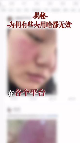 烂脸自救成功的3个真相!不是产品不行是你没做到
为啥全网刷到的烂脸记录都能好
偏偏轮到自己就反复翻车?
做了多年护肤修护,今天把终极原因扒透,敏感肌/悸愫脸直接抄作业!
❶ 舍得用,用量+步骤缺一不可
烂脸期别抠搜!该修护的修护,该保湿的保湿,一步都不能省
修护精华、舒缓面霜足量上脸,皮肤屏障才能吃饱营养快速修护
用量跟不上,再好的产品也白搭,这是最基础的前提!
❷ 信产品,不内耗不瞎折腾
很多人烂脸好不了,根源是心态崩了
用两天没效果就换产品,脸一反复就怀疑人生,内耗比烂脸更伤肤
只要产品安全、修护思路正确,就算偶尔反复,找原因、调方法就好
全身心认准一个方向,修护这件事,心态稳了就赢了一半
❸ 能坚持,好了也不轻易换产品
这是最关键的一点!
烂脸大多是乱换产品、频繁踩坑作出来的
那些修护成功的人,就算脸好了,也会长期坚持同一款靠谱产品
屏障修护是长期工程,稳定比啥都重要,别好了伤疤忘了疼
敏感肌、悸愫脸修护没有捷径
舍得+相信+坚持,这三点做到位,你的脸也能稳稳逆袭✅
你们修护路上还踩过哪些坑?评论区聊聊~ 烂脸自救成功的3个真相!不是产品不行是你没做到
为啥全网刷到的烂脸记录都能好
偏偏轮到自己就反复翻车?
做了多年护肤修护,今天把终极原因扒透,敏感肌/悸愫脸直接抄作业!
❶ 舍得用,用量+步骤缺一不可
烂脸期别抠搜!该修护的修护,该保湿的保湿,一步都不能省
修护精华、舒缓面霜足量上脸,皮肤屏障才能吃饱营养快速修护
用量跟不上,再好的产品也白搭,这是最基础的前提!
❷ 信产品,不内耗不瞎折腾
很多人烂脸好不了,根源是心态崩了
用两天没效果就换产品,脸一反复就怀疑人生,内耗比烂脸更伤肤
只要产品安全、修护思路正确,就算偶尔反复,找原因、调方法就好
全身心认准一个方向,修护这件事,心态稳了就赢了一半
❸ 能坚持,好了也不轻易换产品
这是最关键的一点!
烂脸大多是乱换产品、频繁踩坑作出来的
那些修护成功的人,就算脸好了,也会长期坚持同一款靠谱产品
屏障修护是长期工程,稳定比啥都重要,别好了伤疤忘了疼
敏感肌、悸愫脸修护没有捷径
舍得+相信+坚持,这三点做到位,你的脸也能稳稳逆袭✅
你们修护路上还踩过哪些坑?评论区聊聊~#敏感肌 #大红脸 #泛红 #角质层薄 #屏障受损