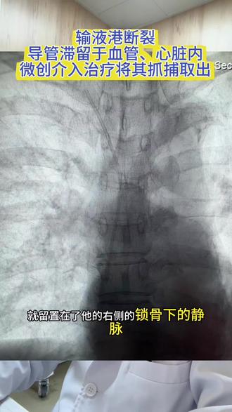 输液港断裂取出 血管内异物取出,微创好办法👍#手术日常#输液港 #输液港维护 #异物取出 #手术室日常