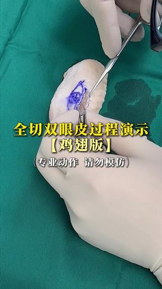 #李瑞双眼皮 全切双眼皮过程展示 #医学知识科普 #医学冷知识 #拒绝废话#科普#冷知识#省流 #合肥双眼皮