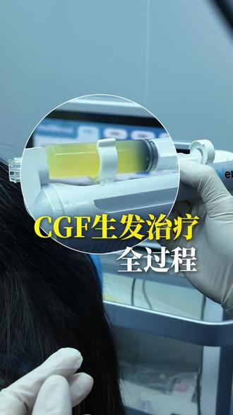 自己的血居然能长头发! CGF生发原理是什么?#CGF #生发 #真实生活分享计划 #科普