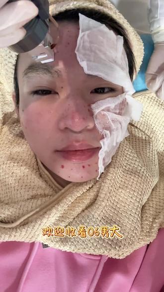 年前逆袭!!!#黄金微针 #肉毒 #刷酸 #变美逆袭