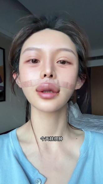 人中窝加深+嘴角上扬恢复过程
#人中 #人中窝加深 #嘴角上扬 #罗澜涛 #微笑唇