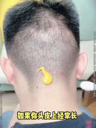 因为专业值得信赖。头皮痒,头屑多,头上长小圪塔,头发油腻的朋友,我力荐你用用这款毛囊清洁洗发水