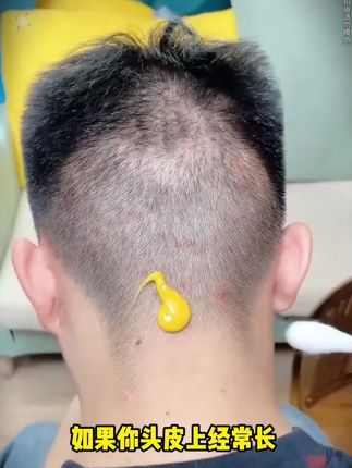 头皮痒,头屑多,头发出油?螨虫惹的祸!试试这款毛囊清洁洗发水,控油去屑!#去屑