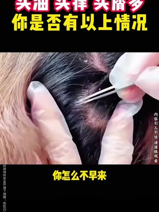 一般颜值不高的产品都有你意想不到的强大功效。比如这款毛囊清洁洗发水#控油去屑#二硫化硒洗发水#去屑止痒