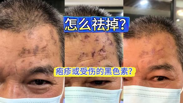 怎么祛掉?疱疹或者受伤引起的黑色素?#色素沉淀