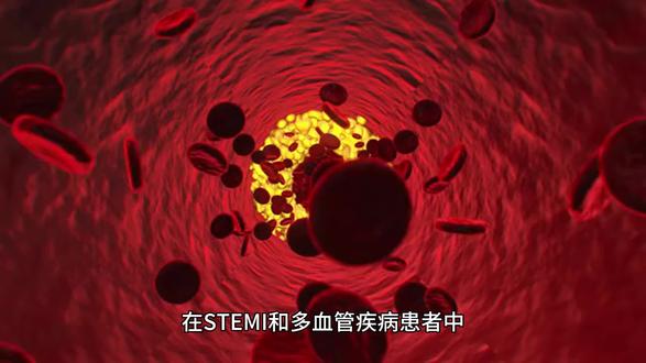 完全血运重建术由于仅病变处的经皮冠状动脉介入治疗策略