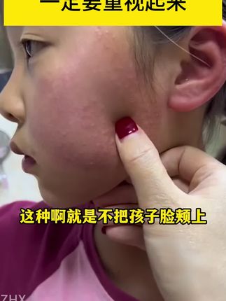 【爆款】青春期孩子脸部护理很重要 这款植物大师祛痘膏 深得我心 给孩子用正合适#国货老品牌#平价祛痘好物
