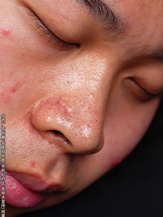 草莓鼻真的狠狠地爱上了它,还得是咱们老品牌,我叫它毛孔吸尘器!!#种草 #亲测分享 #NATS #泥膜棒