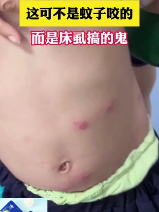 如果你经常浑身刺痒,头发易掉落,背上爱长痘,那么你的床上有螨虫在作怪!赶紧备上这个除螨包试试吧