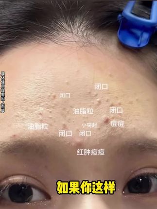 青春期孩子脸部护理很重要 这款氨基酸洗面奶 深得我心 给孩子用正合适 #一花一个新世界#植祛洗面奶 #护肤