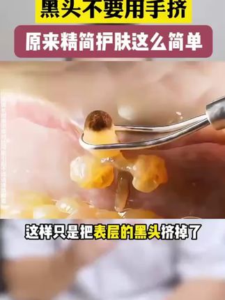 后悔没有早点发现这么好的壬二酸泥膜棒,大家都在用,便宜又好用! "泥膜 "#护肤#面部护理#脸部清洁#白云山壬二酸泥膜