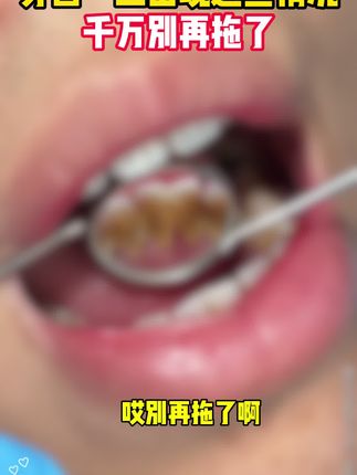它不是牙膏,它是牙色剥离剂#牙膏#宫教授牙膏#牙黄#白牙