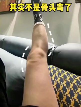 小-腿-歪-翻、膝-盖弧度歪的,都给我把足弓垫焊死在鞋里!!垫了没垫差别是真的很大#直腿足弓垫 #足弓垫 #足弓塌陷